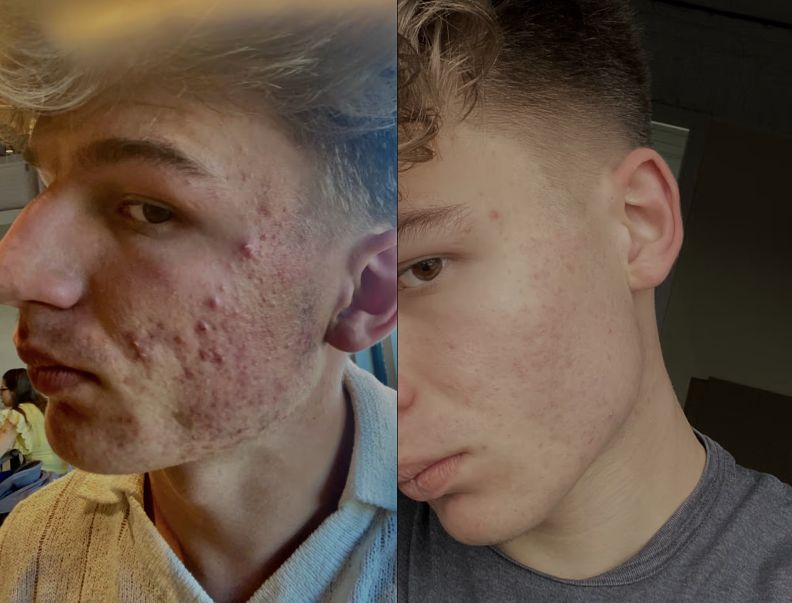 Darm, Immunsystem und Hautbild